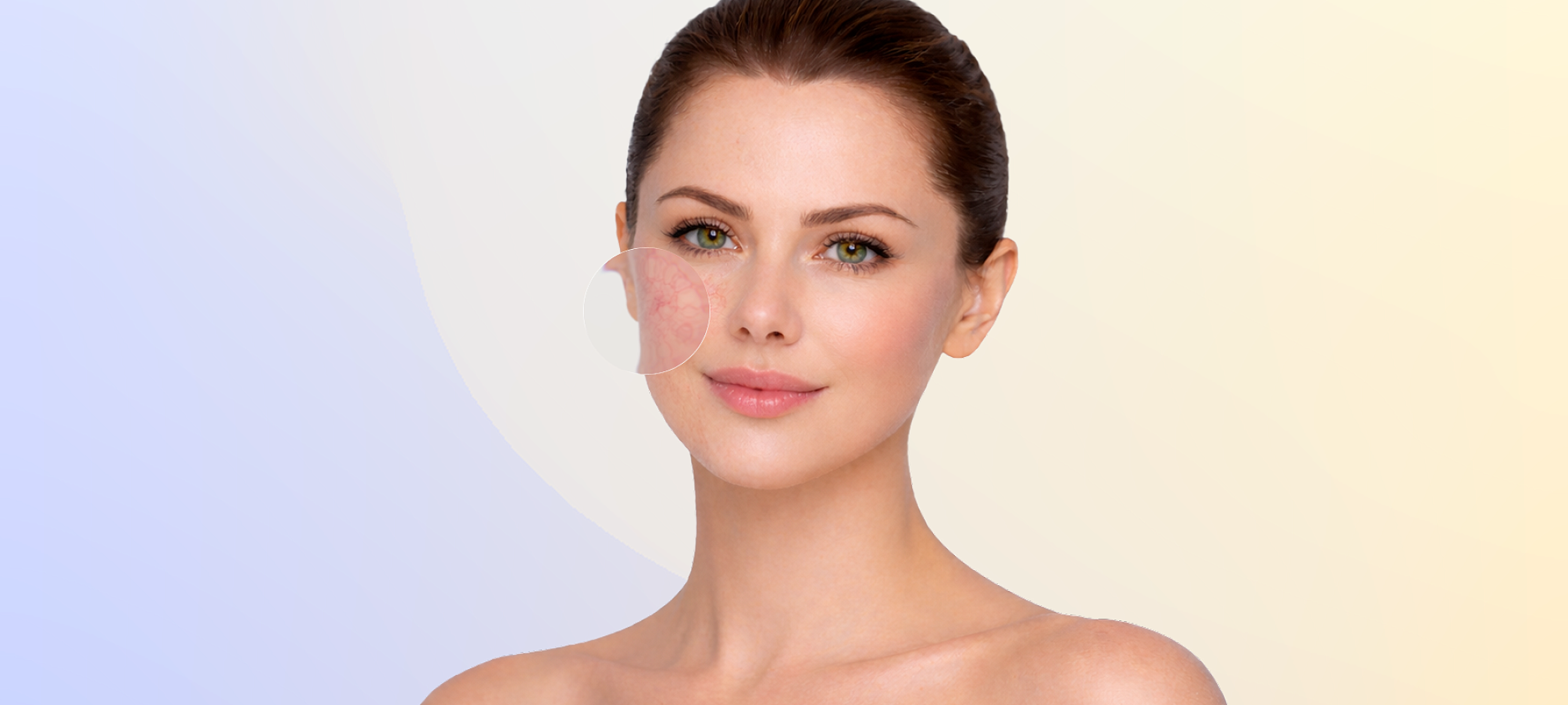 Удаление сосудов на лице и теле