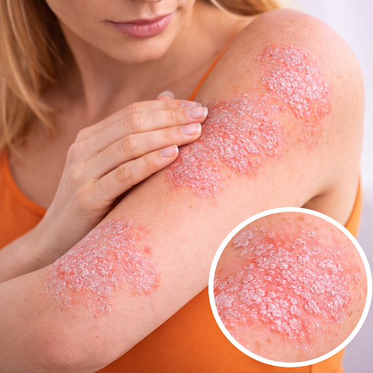 Верните здоровье и чистоту вашей коже: современные методы лечения псориаза с длительной ремиссией.